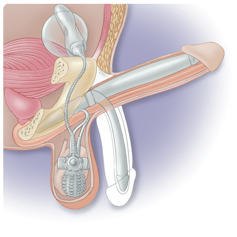 Erektionsprothese - DAVERIO-TRANSsurgery-GROUP